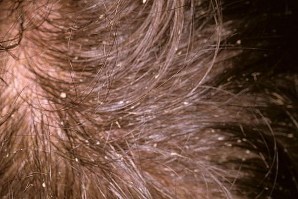 Cách chữa nấm da đầu bằng phương pháp dân gian an toàn và hiệu quả