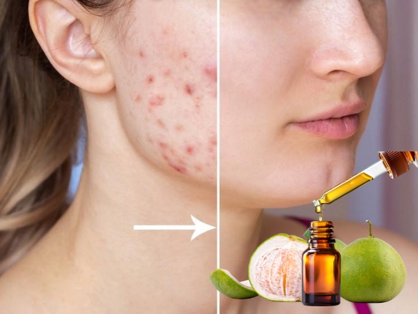 Tinh dầu bưởi giúp hạn chế vi khuẩn gây mụn, kiểm soát bã nhờn