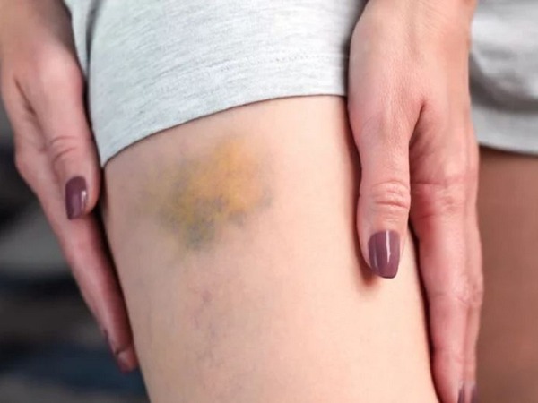 Giảm đau cơ, tan vết bầm với tinh dầu khuynh diệp