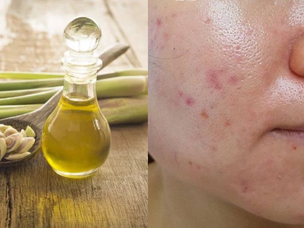 Tinh dầu sả chanh giúp kiểm soát dầu thừa, giảm bít tắc lỗ chân lông